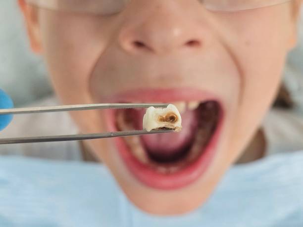 Best Emergency Dental Extractions in Fort Washakie, WY